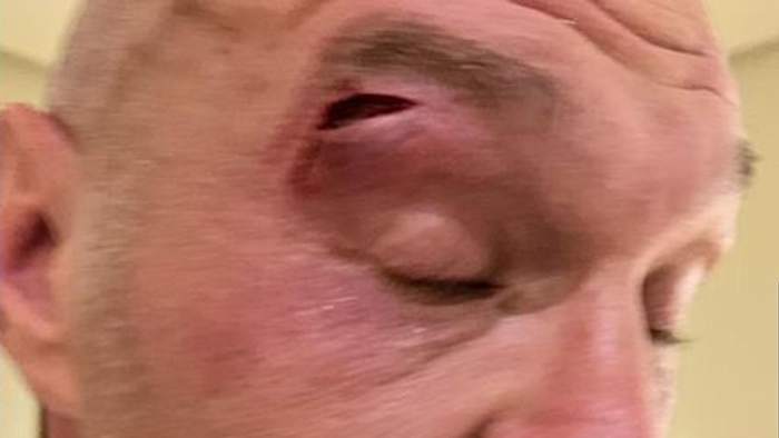 Undisputed Heavyweight Champion Tyson Fury sustains a cut during sparring, forcing the fight to be rescheduled. X/QUEENSBERRY PROMOTIONS.